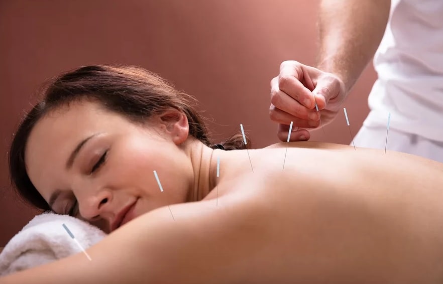 Best acupuncture services in Calgary - Acupuncture clinic in Calgary - Rhema Gold Physiorehab